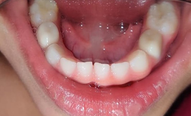Esthetic Crowns Lower after