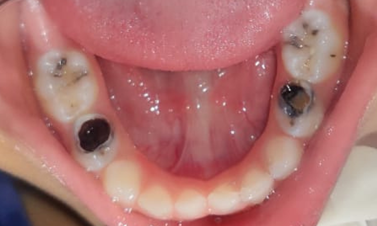Esthetic Crowns Lower before