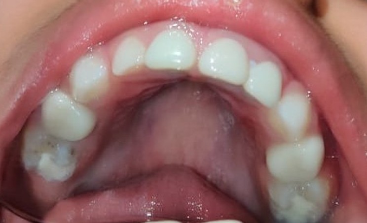 Esthetic Crown Upper after