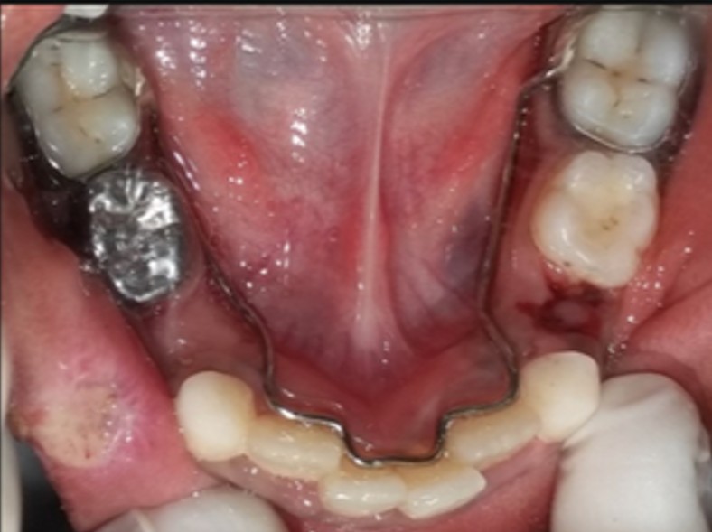 Space Maintainer Lower after