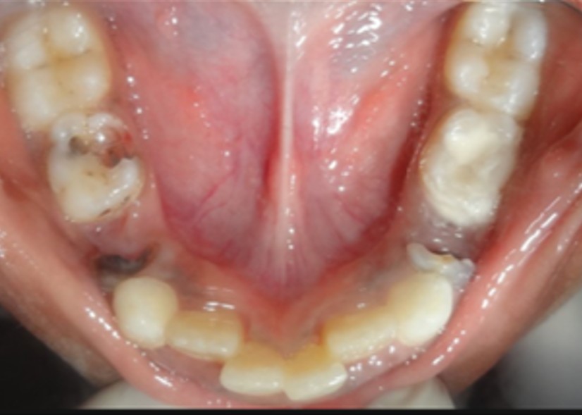 Space Maintainer Lower before