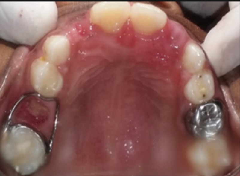 Space Maintainer Upper after