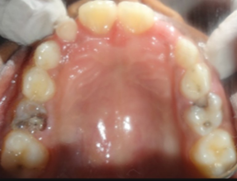 Space Maintainer Upper before