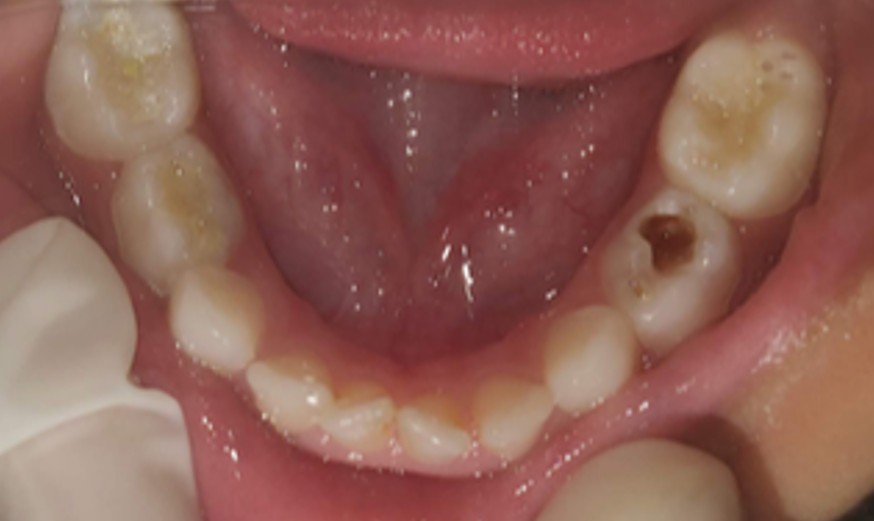 Zirconia Crowns before