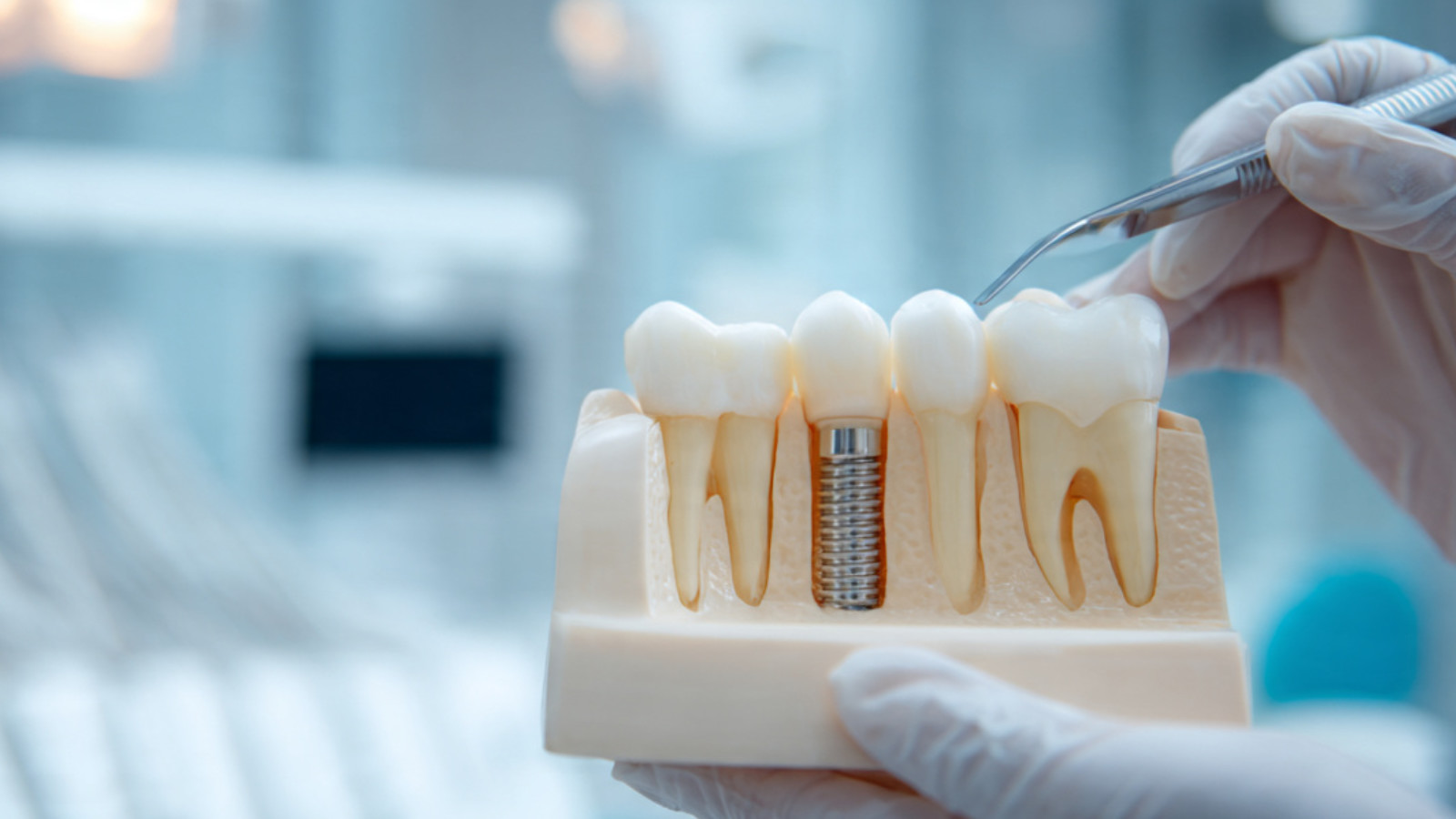 Diagram showing dental implant structure
